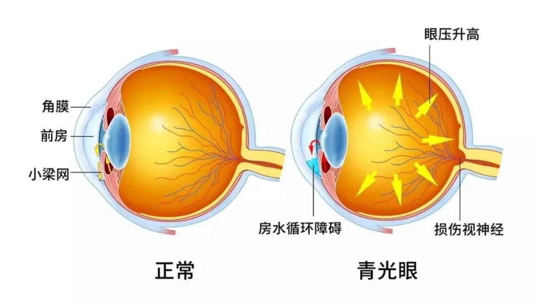 什么是青光眼，您了解吗？