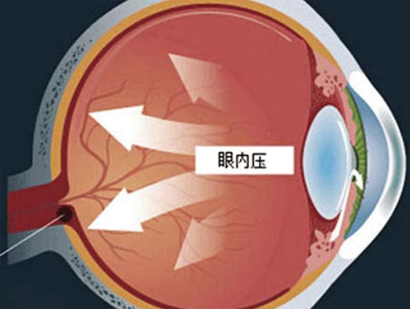 眼压高的人都是青光眼吗？