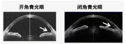 青光眼要早预防早发现早