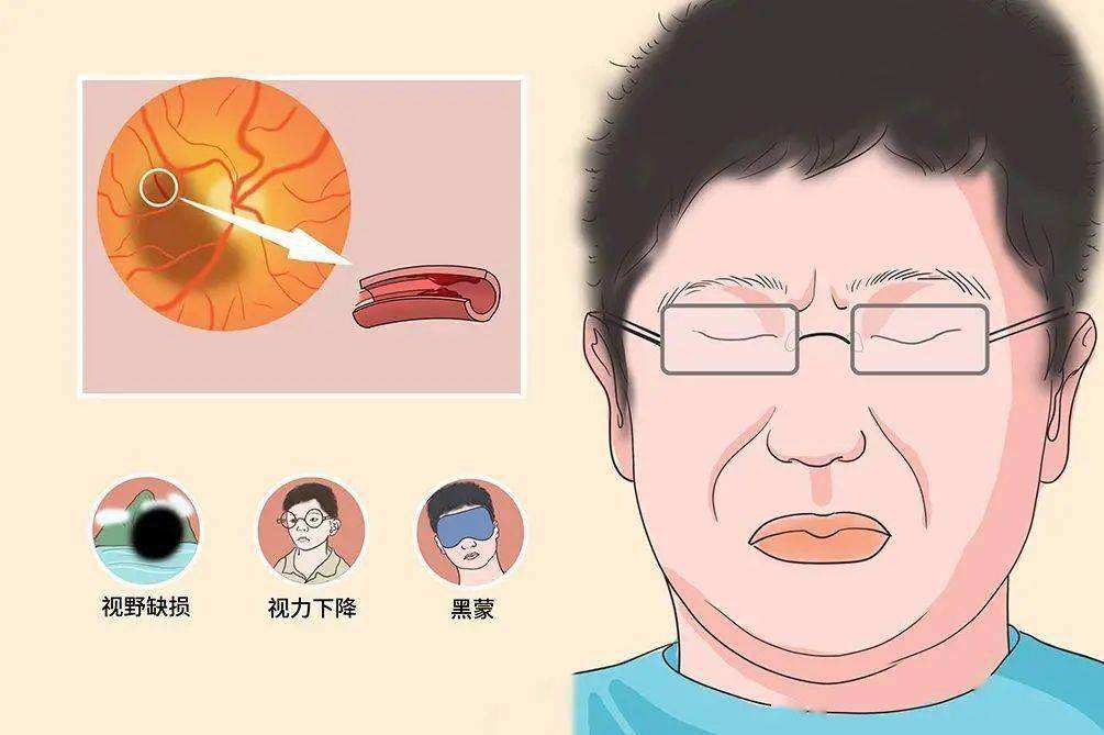 冬季视力突然下降，小心眼中风