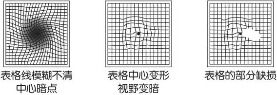 玩手机导致眼部黄斑病变？