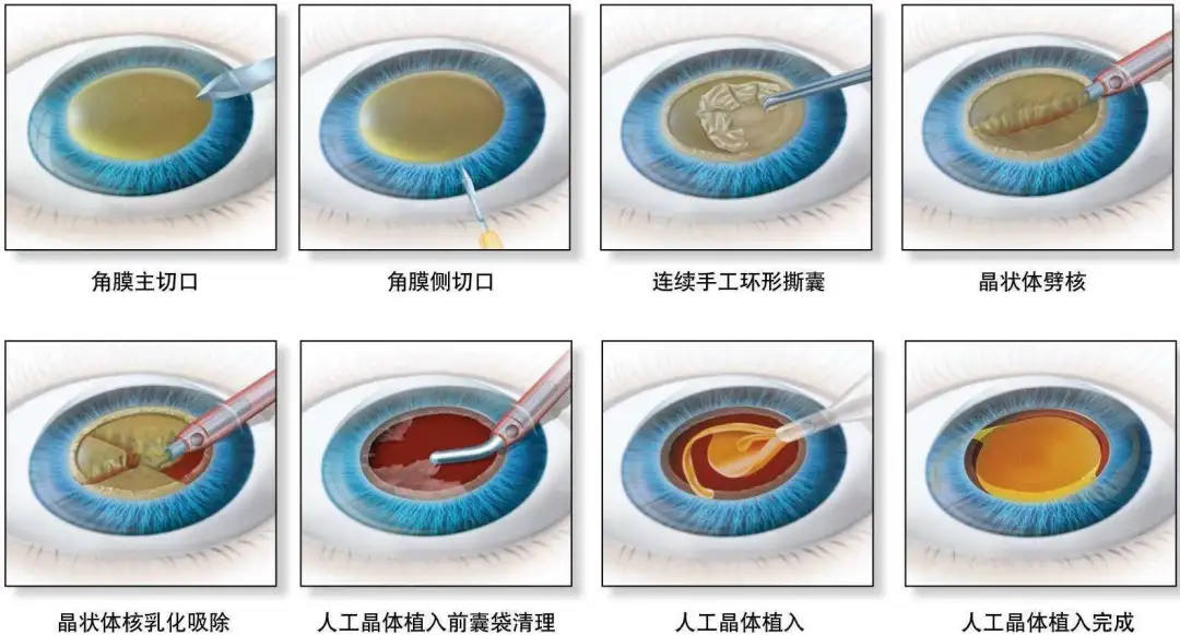 白内障——每个人都可能遇到的致盲危机