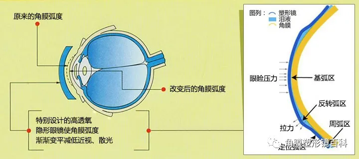 「」真的是控制近视度数增长神器？