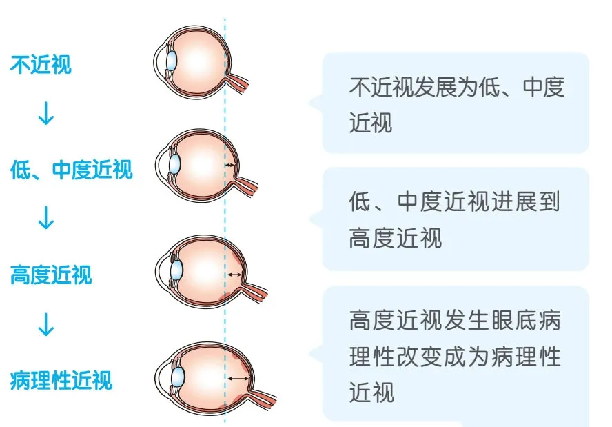 近视眼必看 | 高度近视形成的3个阶段