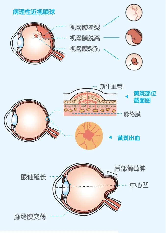 近视眼必看 | 高度近视形成的3个阶段