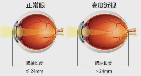 近视眼必看 | 高度近视形成的3个阶段