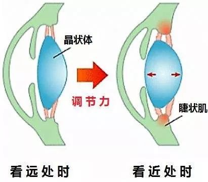 说的就是你，那个做了近视手术的
