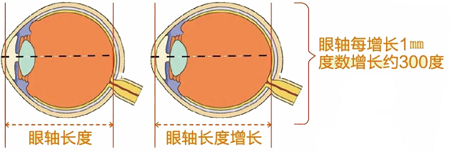 近视手术的年龄秘密之谜