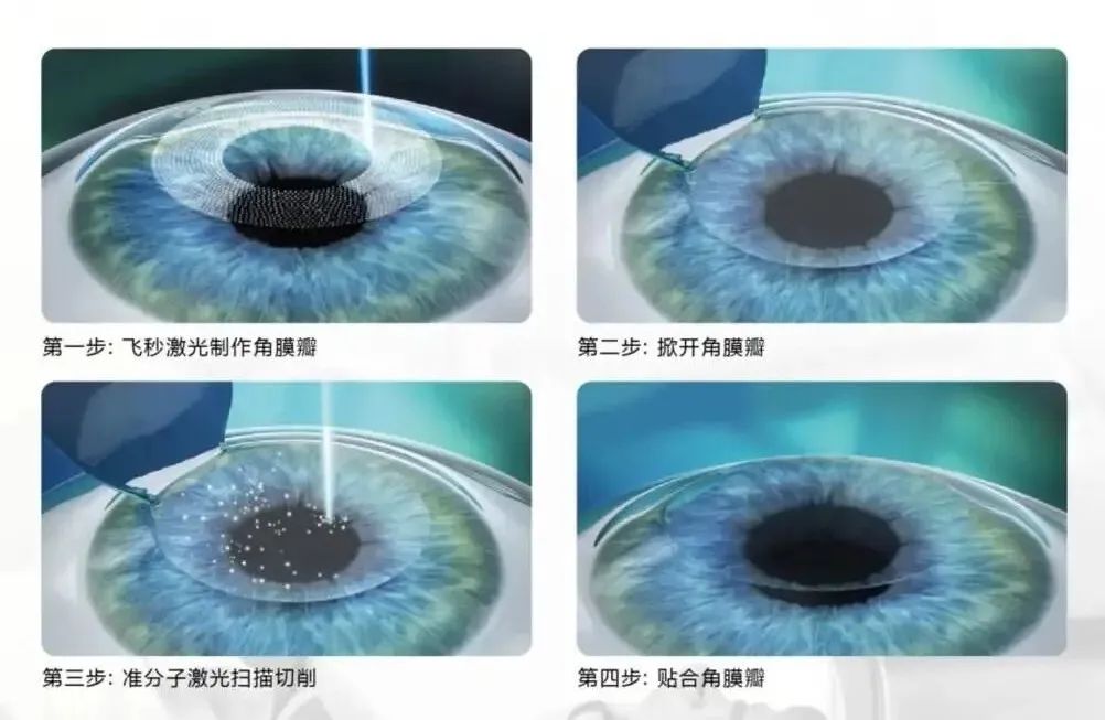 想要做近视手术？要先关注这4个问题