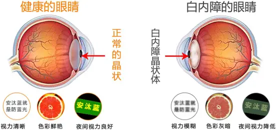 老年人视力下降是老花眼，还是白内障-看完你就懂了