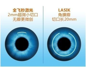 飞秒激光哪种手术更适合你