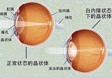 白内障症状及方法