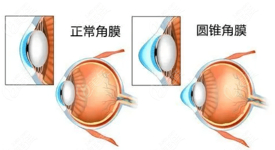 守护角膜健康